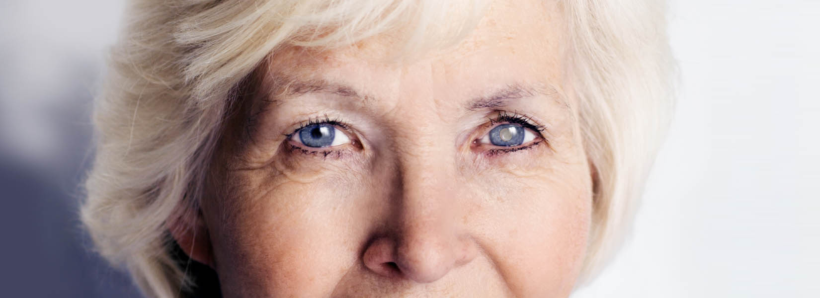 Cataract Surgery in Lexington